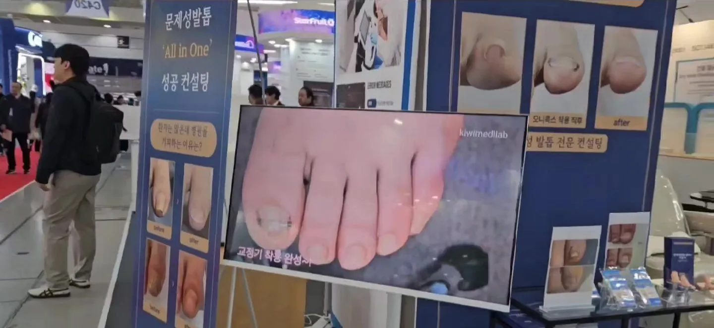 KIMES 의료기기 전시회 KIWI MEDI-LAB 부스에서 문제성 발톱 교정 전후 사례 패널과 제품을 전시한 모습